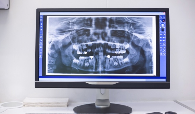 Computer monitor showing digital x rays of teeth