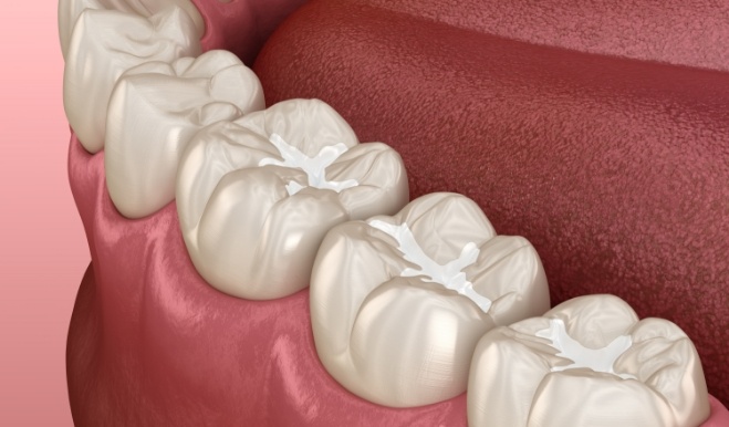 Illustrated row of teeth with tooth colored fillings in San Marcos