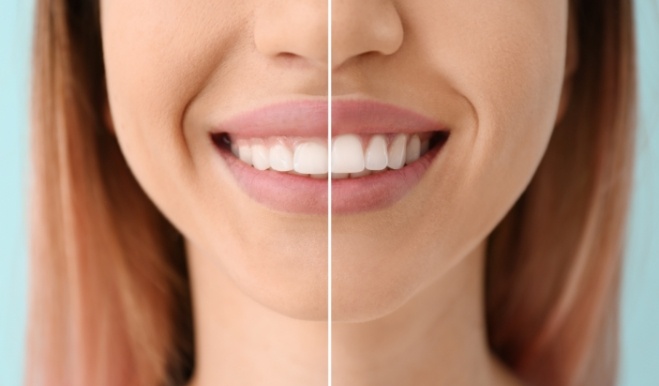 Close up of woman smiling before and after gummy smile correction