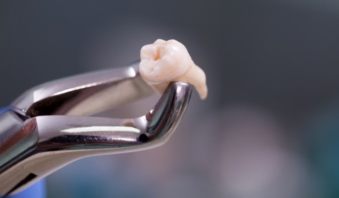 Dental clasps holding an extracted tooth
