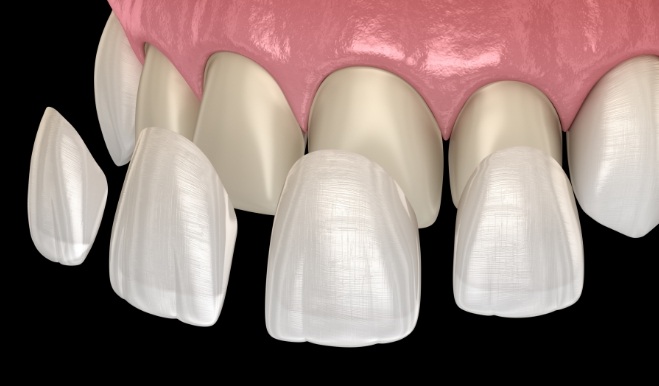 Illustration of several veneers being placed over front surfaces of teeth