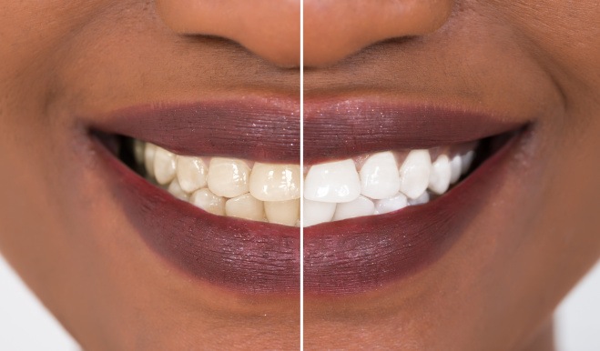 Patient's smile before and after teeth whitening