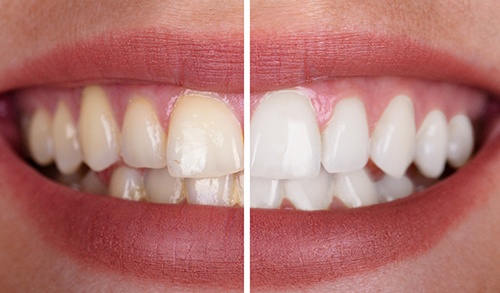 Up-close view of stained and brighter teeth